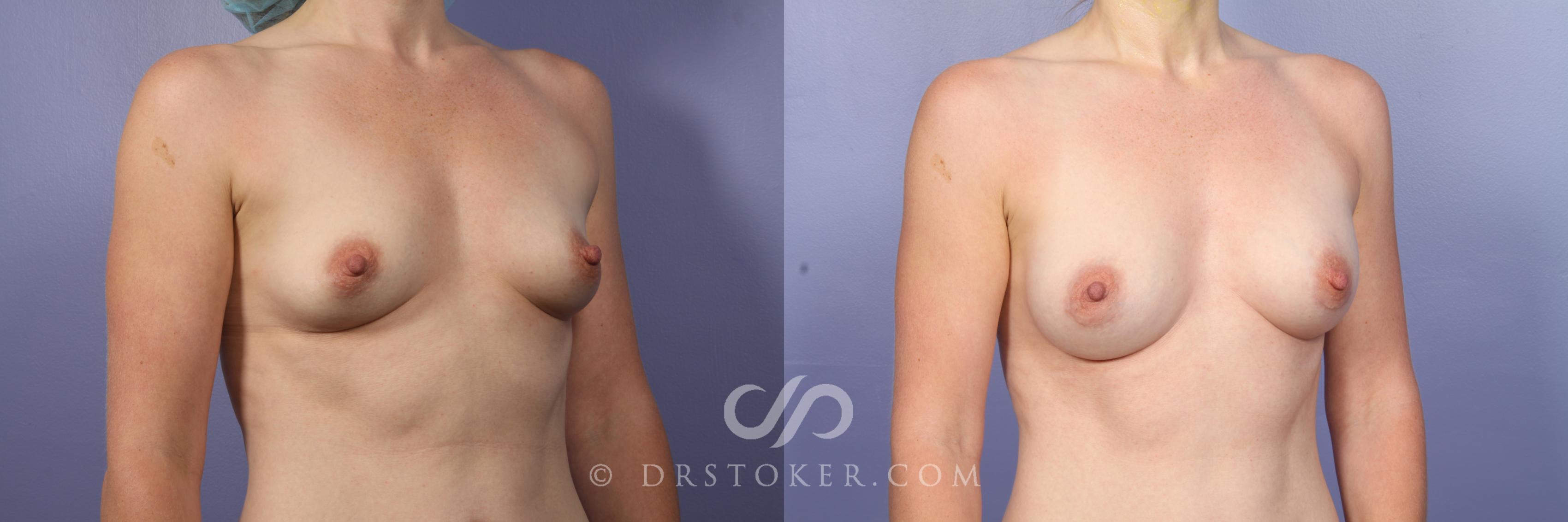 Before & After Breast Augmentation, Rapid Recovery Case 472 View #4 View in Los Angeles, CA