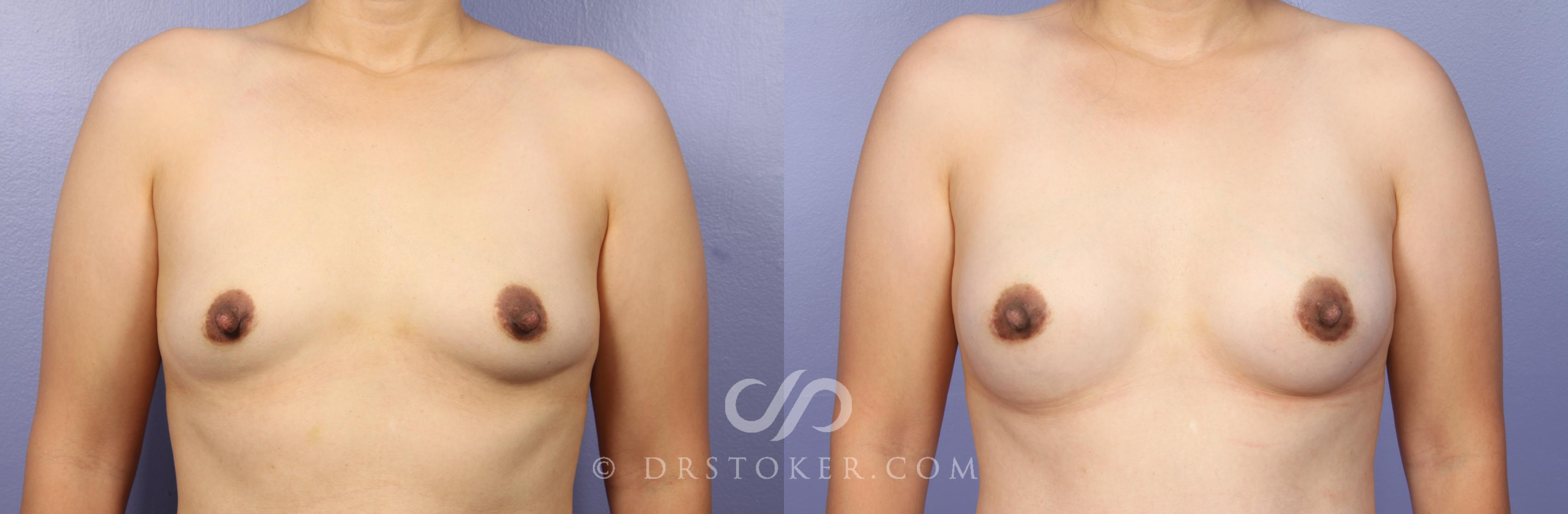 Before & After Breast Augmentation, Rapid Recovery Case 473 View #1 View in Los Angeles, CA