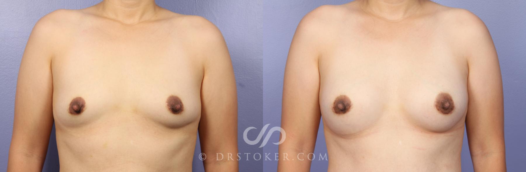 Before & After Breast Augmentation, Rapid Recovery Case 473 View #1 View in Los Angeles, CA
