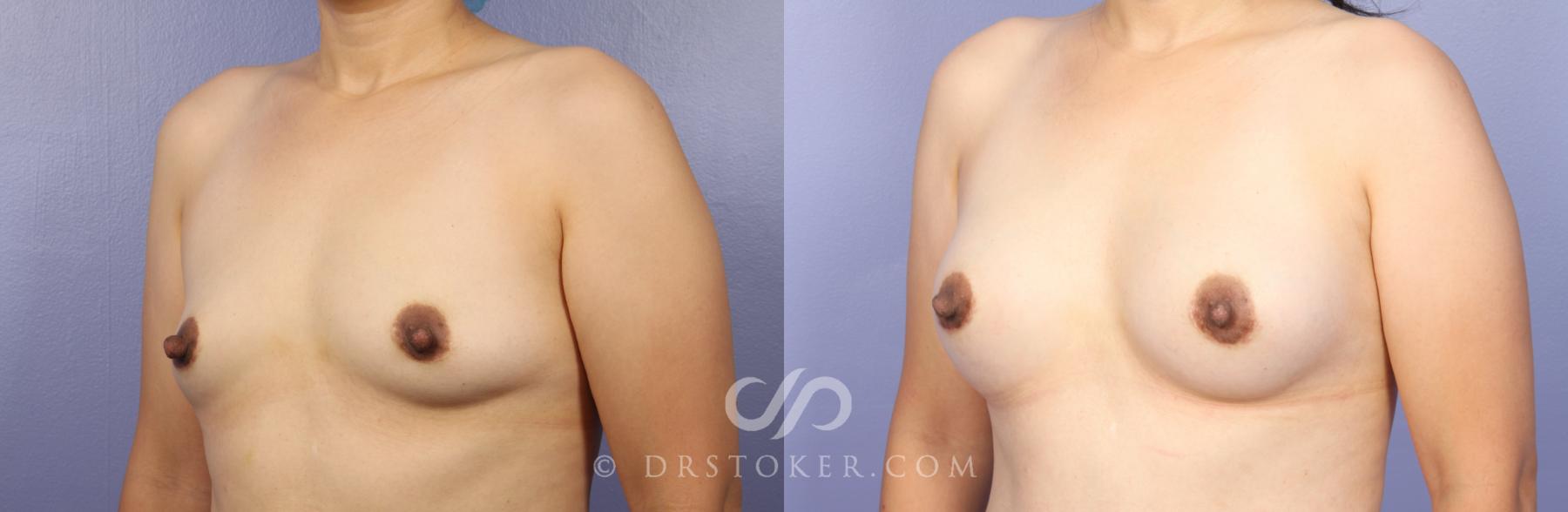 Before & After Breast Augmentation, Rapid Recovery Case 473 View #2 View in Los Angeles, CA
