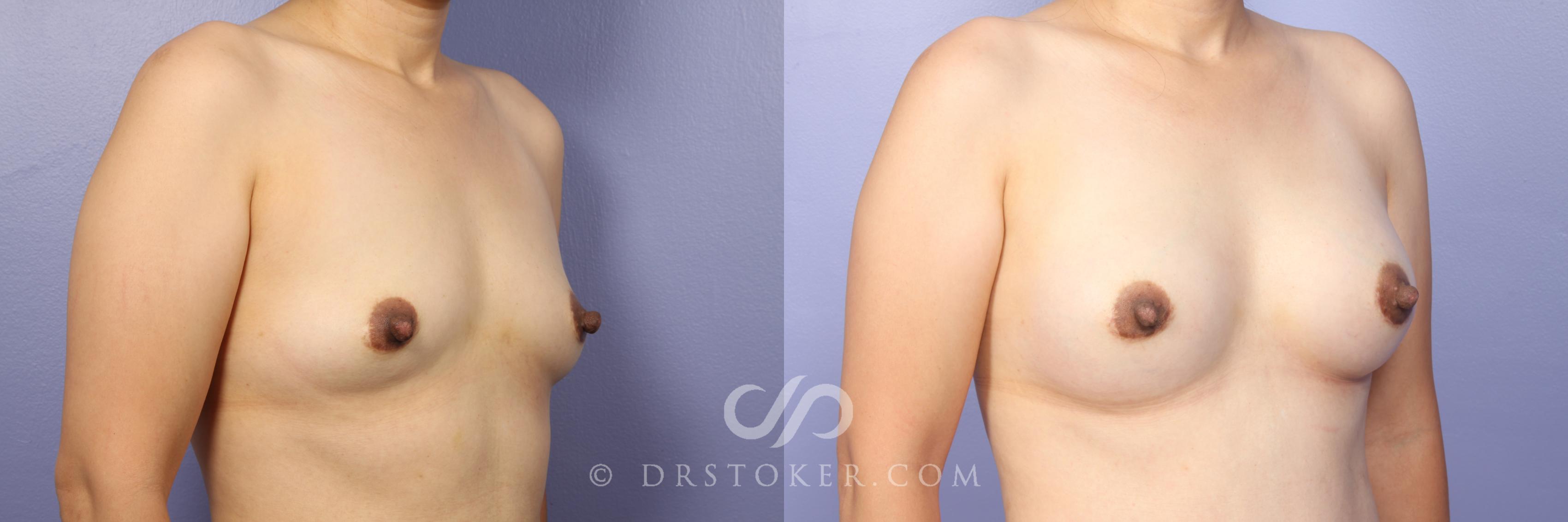 Before & After Breast Augmentation, Rapid Recovery Case 473 View #3 View in Los Angeles, CA