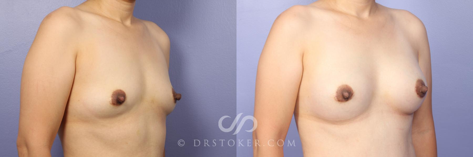 Before & After Breast Augmentation, Rapid Recovery Case 473 View #3 View in Los Angeles, CA