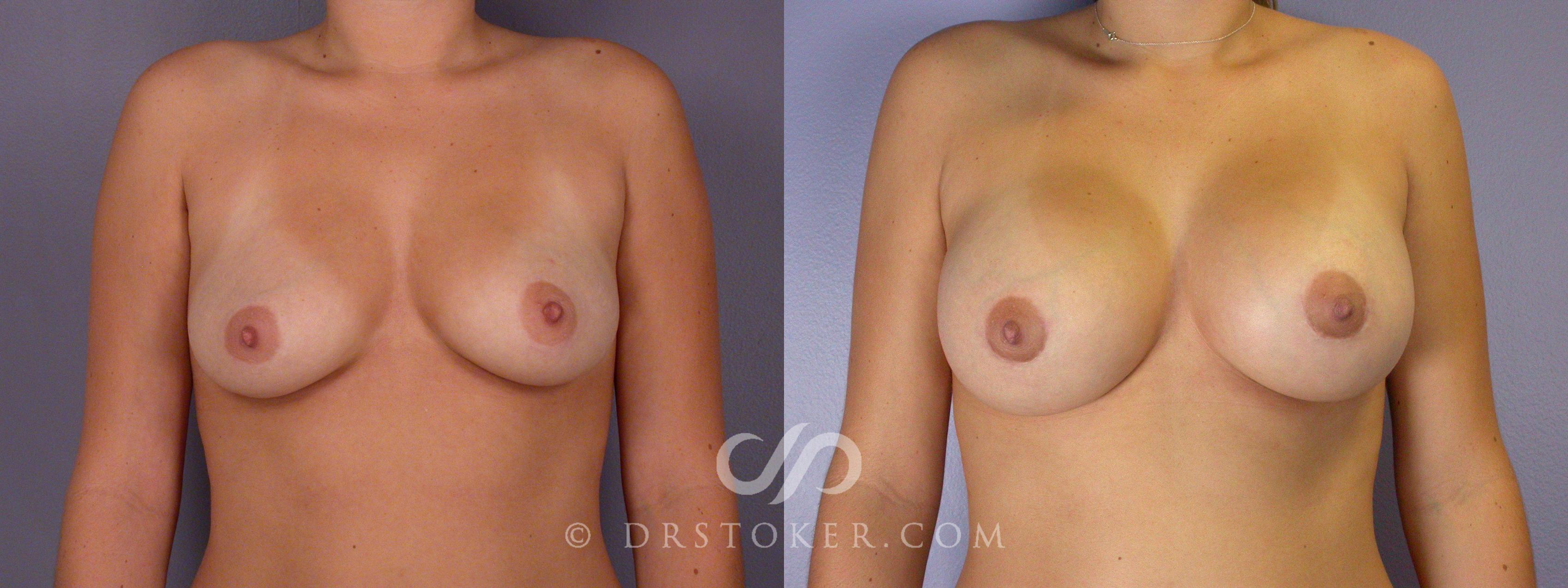 Before & After Rapid Recovery Breast Augmentation Case 502 View #1 View in Los Angeles, CA