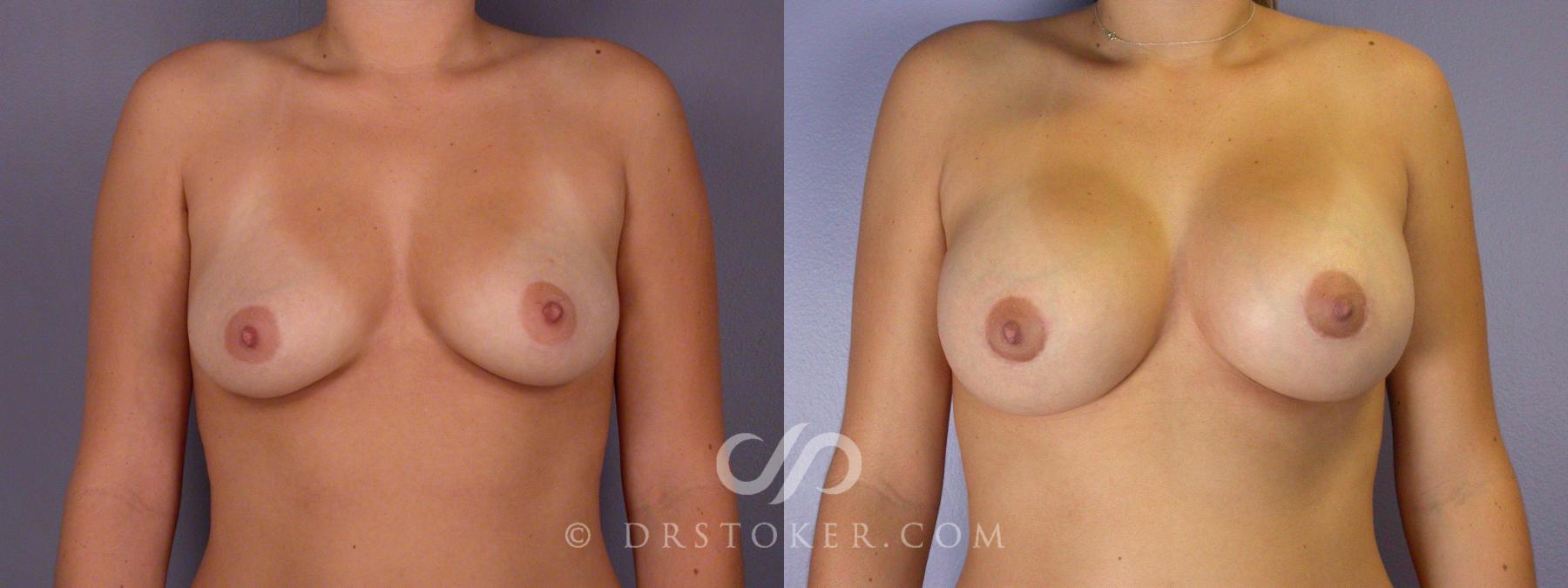 Before & After Breast Augmentation, Rapid Recovery Case 502 View #1 View in Los Angeles, CA