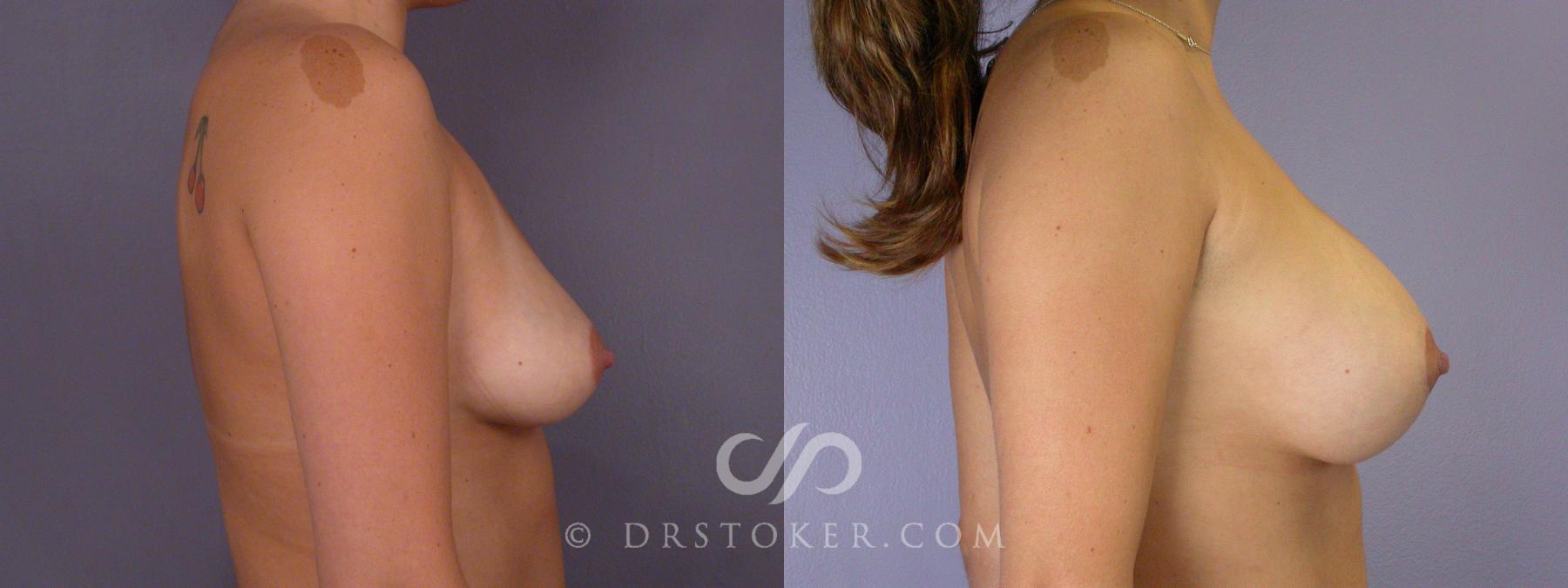 Before & After Breast Augmentation, Rapid Recovery Case 502 View #3 View in Los Angeles, CA