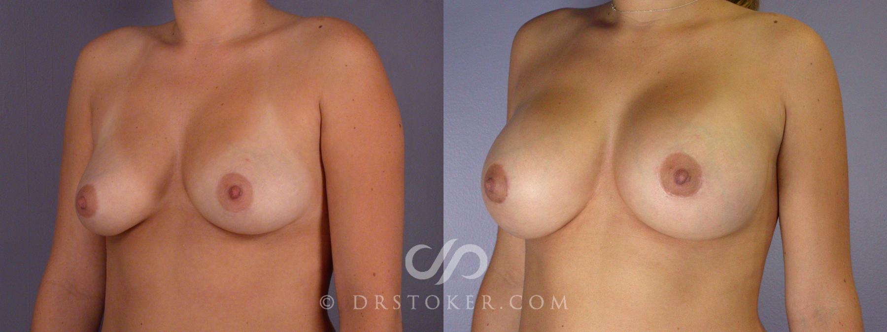 Before & After Breast Augmentation, Rapid Recovery Case 502 View #4 View in Los Angeles, CA