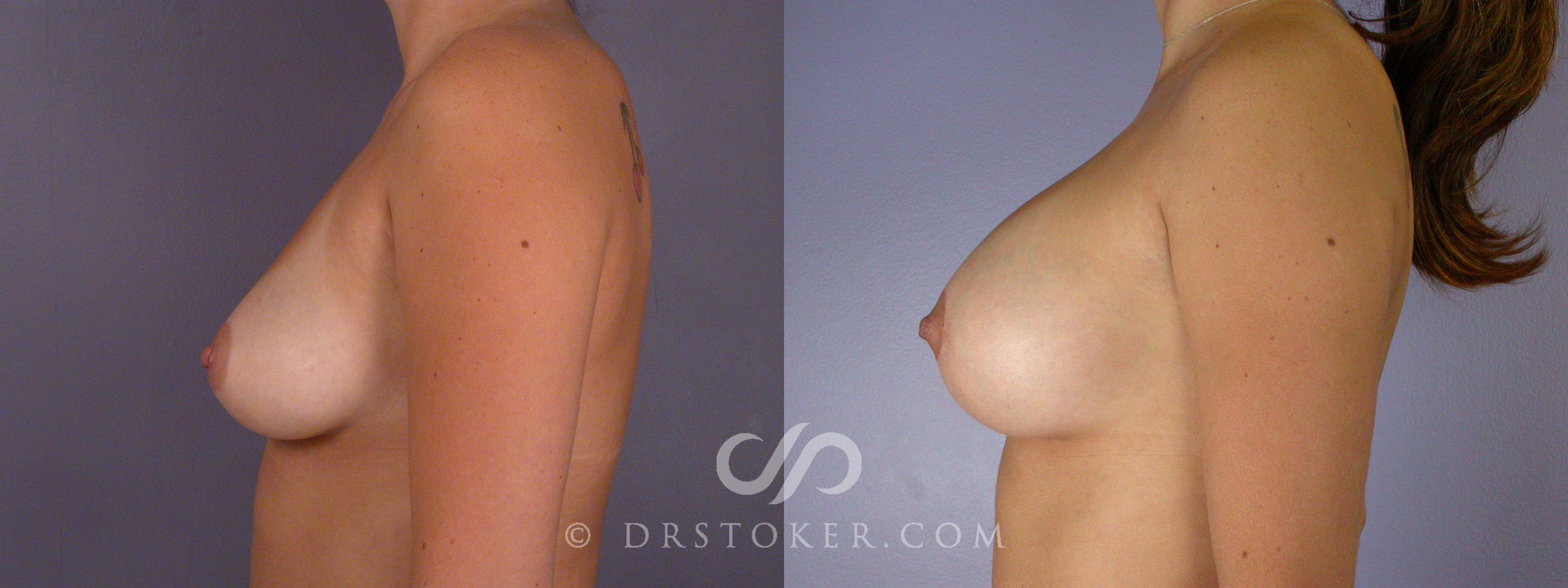 Before & After Rapid Recovery Breast Augmentation Case 502 View #5 View in Los Angeles, CA