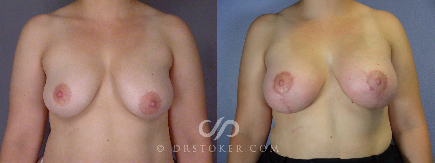 Before & After Breast Augmentation, Rapid Recovery Case 509 View #1 View in Los Angeles, CA