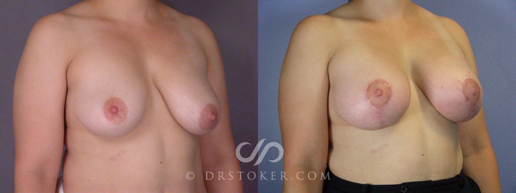 Before & After Breast Augmentation with Lift Case 509 View #2 View in Los Angeles, CA