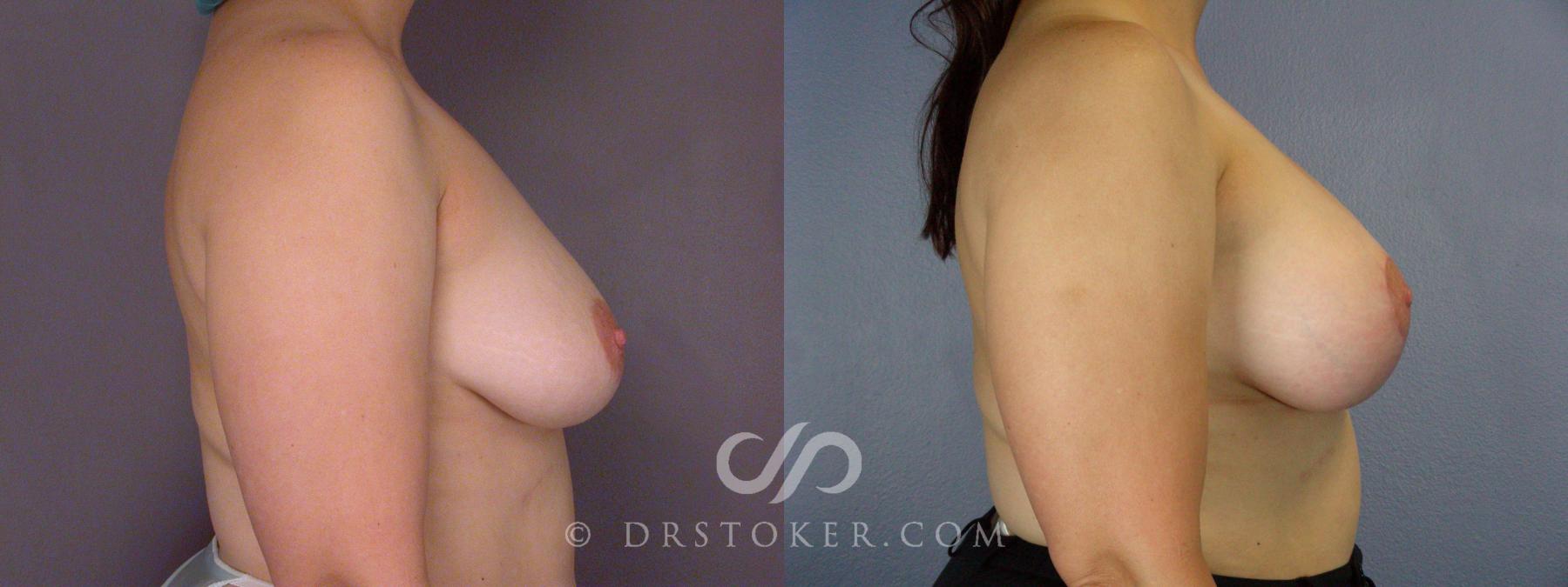 Before & After Breast Asymmetry Correction Case 509 View #4 View in Los Angeles, CA