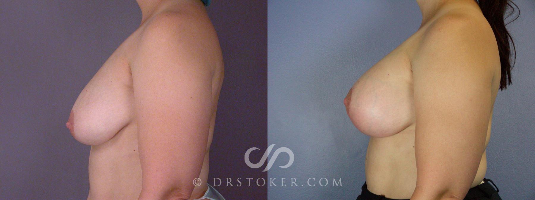 Before & After Breast Asymmetry Correction Case 509 View #5 View in Los Angeles, CA