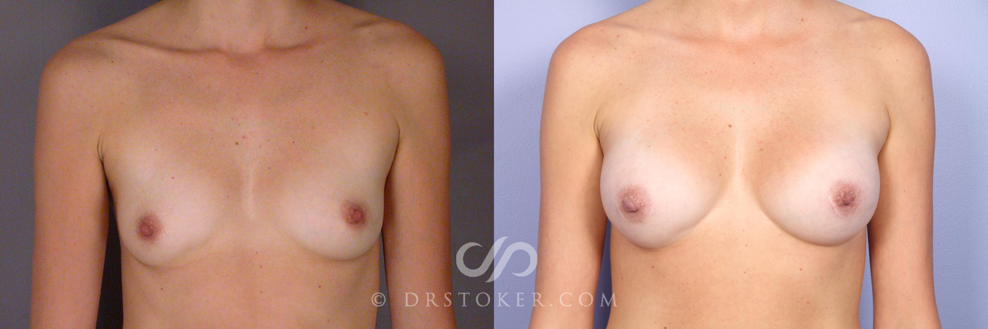 Before & After Breast Augmentation, Rapid Recovery Case 528 View #1 View in Los Angeles, CA
