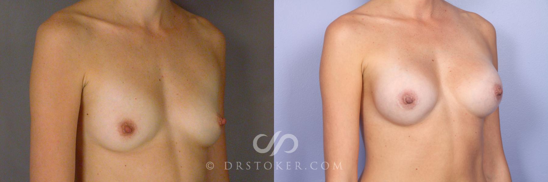 Before & After Breast Augmentation, Rapid Recovery Case 528 View #2 View in Los Angeles, CA