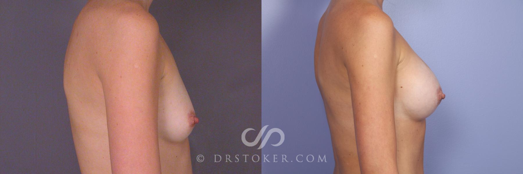 Before & After Breast Augmentation, Rapid Recovery Case 528 View #3 View in Los Angeles, CA