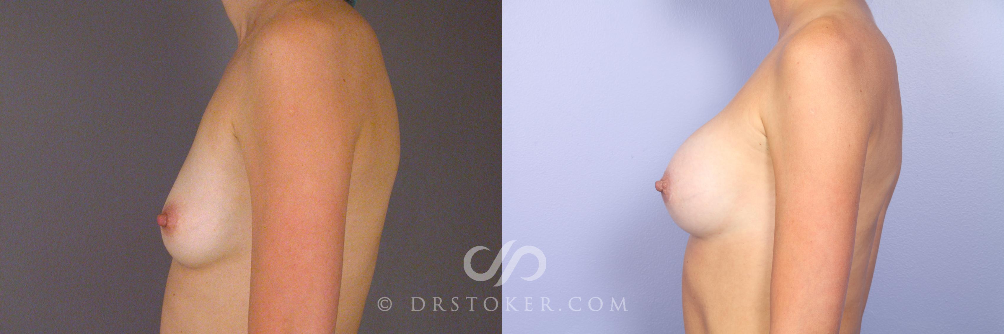 Before & After Breast Augmentation, Rapid Recovery Case 528 View #5 View in Los Angeles, CA