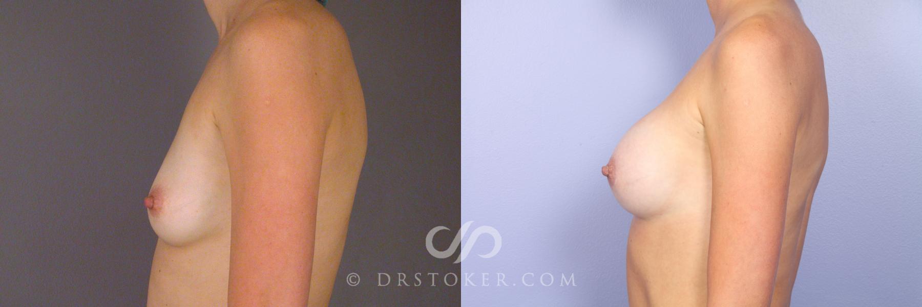 Before & After Breast Augmentation, Rapid Recovery Case 528 View #5 View in Los Angeles, CA