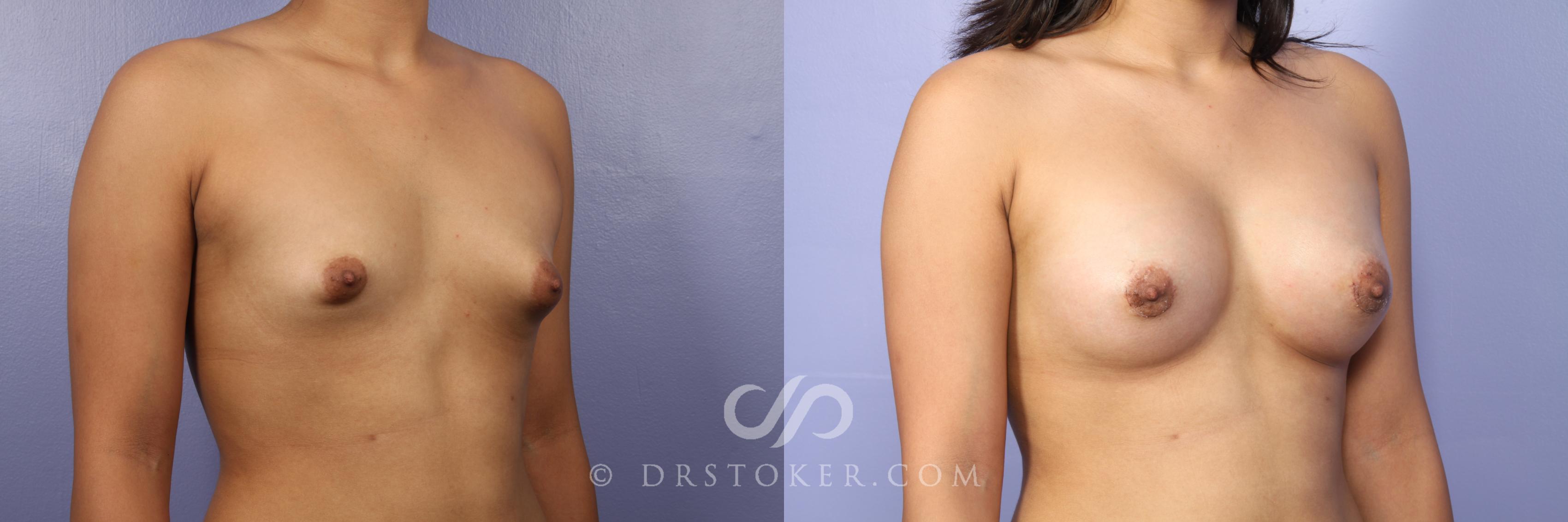 Before & After Breast Augmentation, Rapid Recovery Case 529 View #2 View in Los Angeles, CA