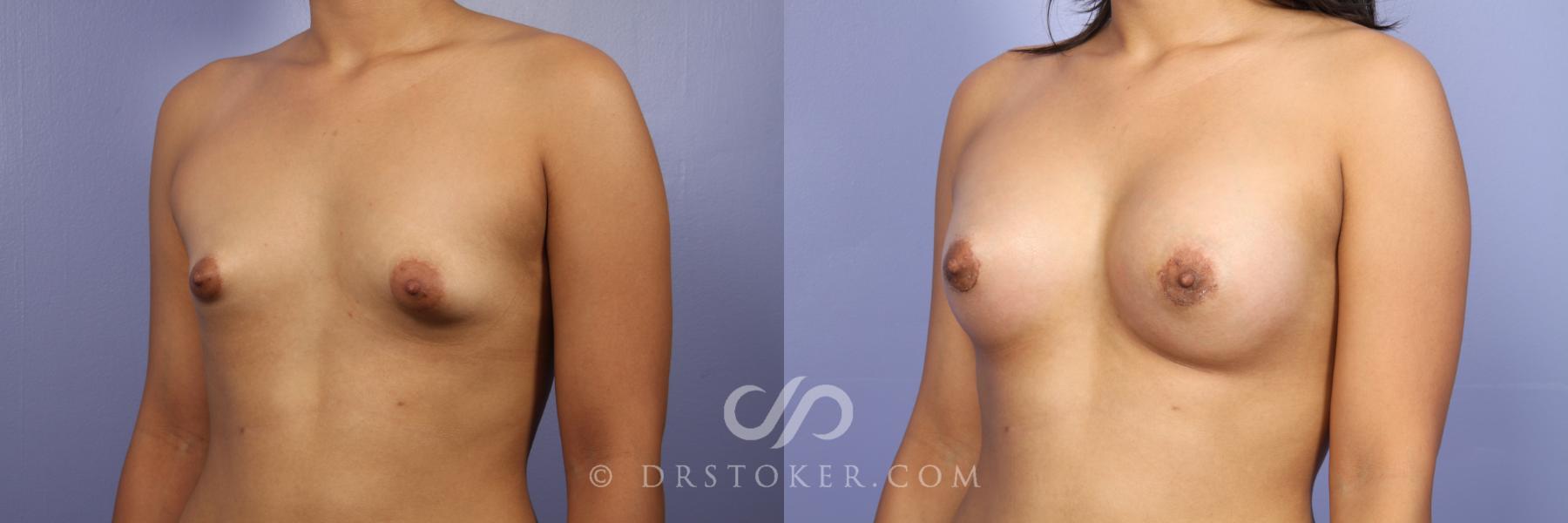 Before & After Breast Asymmetry Correction Case 529 View #3 View in Los Angeles, CA