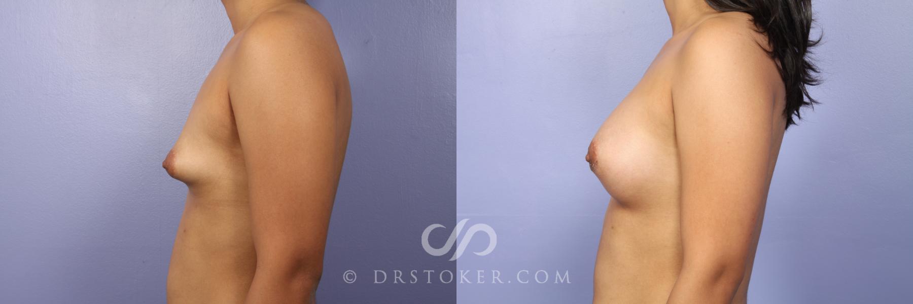 Before & After Breast Augmentation, Rapid Recovery Case 529 View #5 View in Los Angeles, CA