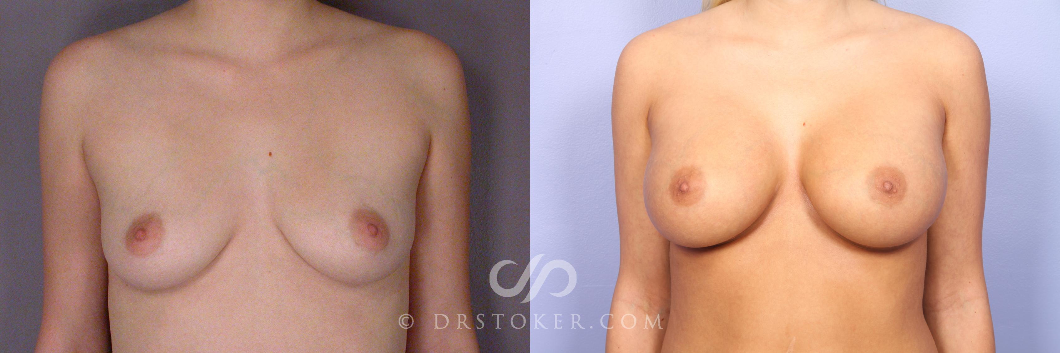 Before & After Breast Augmentation, Rapid Recovery Case 531 View #1 View in Los Angeles, CA