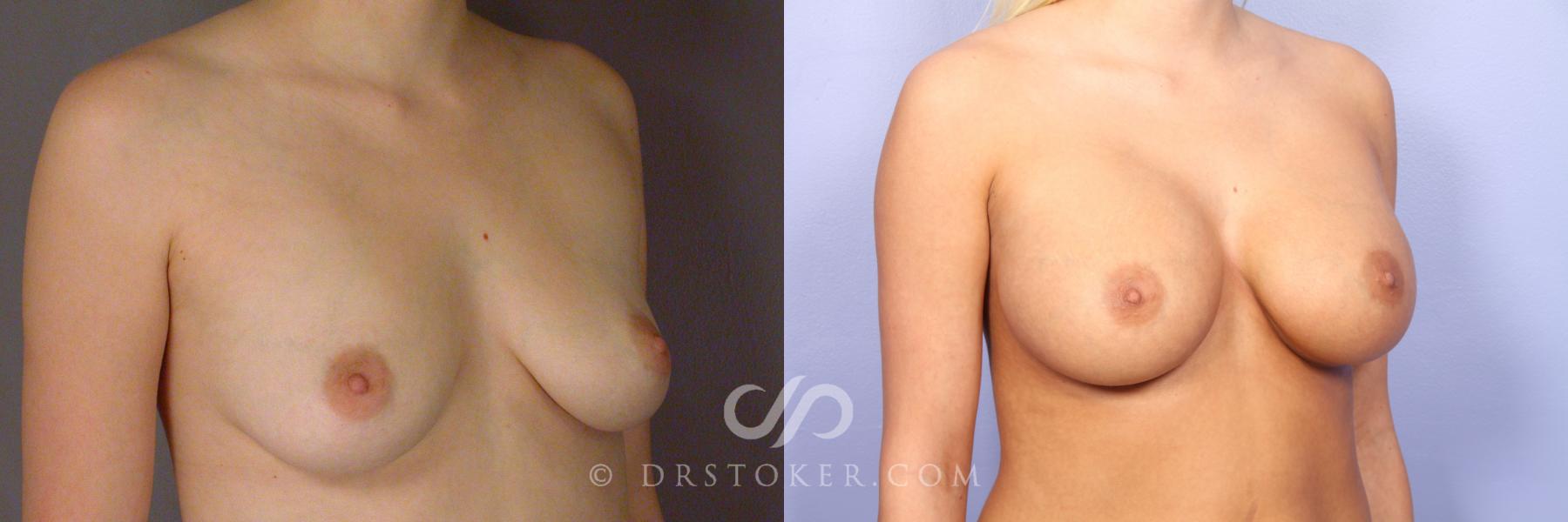Before & After Breast Augmentation, Rapid Recovery Case 531 View #2 View in Los Angeles, CA