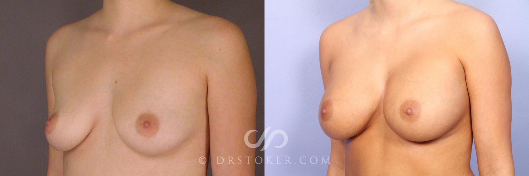 Before & After Breast Augmentation, Rapid Recovery Case 531 View #4 View in Los Angeles, CA