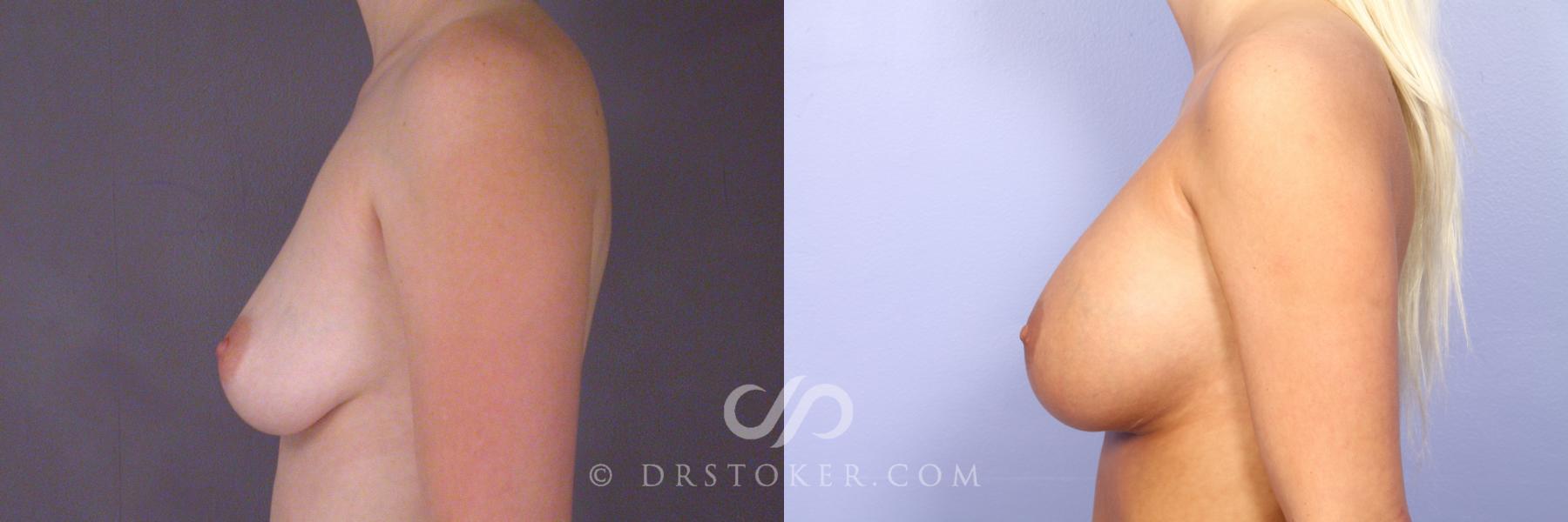 Before & After Breast Augmentation, Rapid Recovery Case 531 View #5 View in Los Angeles, CA