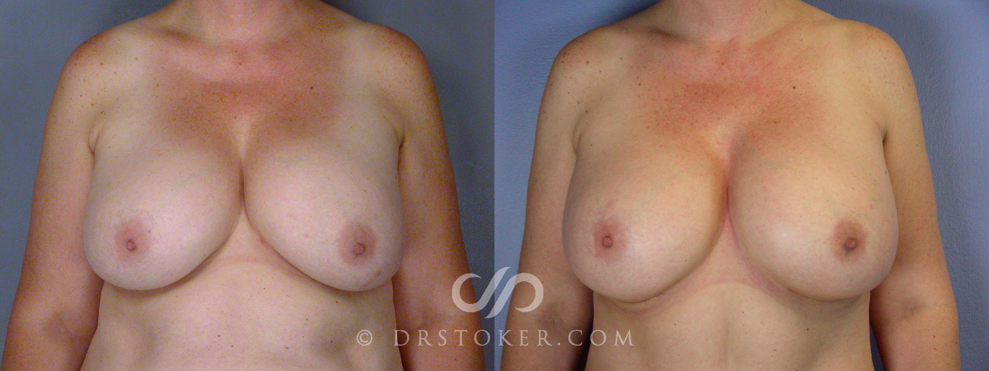 Before & After Breast Implant Correction Case 532 View #1 View in Los Angeles, CA