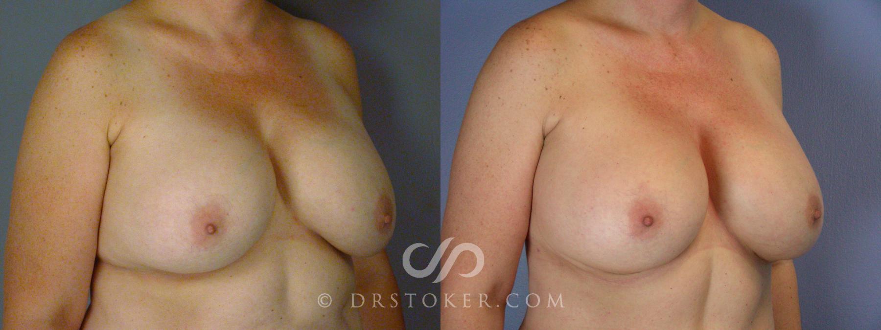 Before & After Breast Implant Correction Case 532 View #2 View in Los Angeles, CA