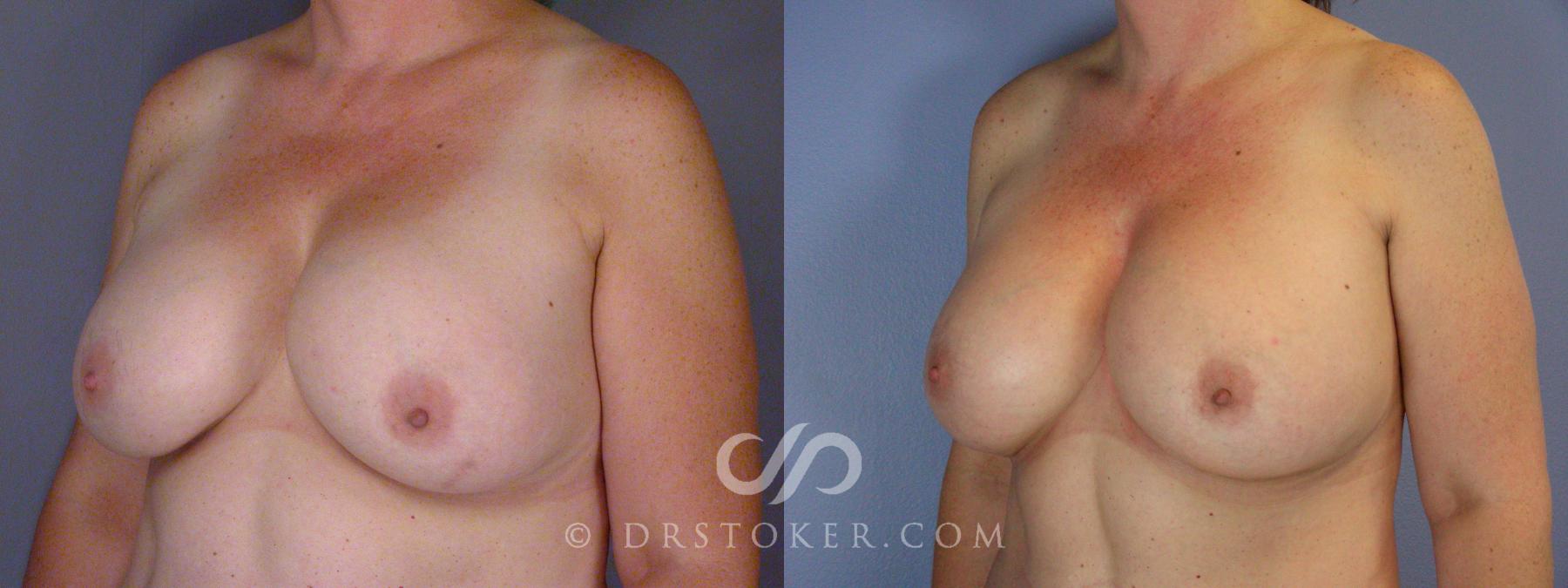 Before & After Breast Implant Correction Case 532 View #4 View in Los Angeles, CA