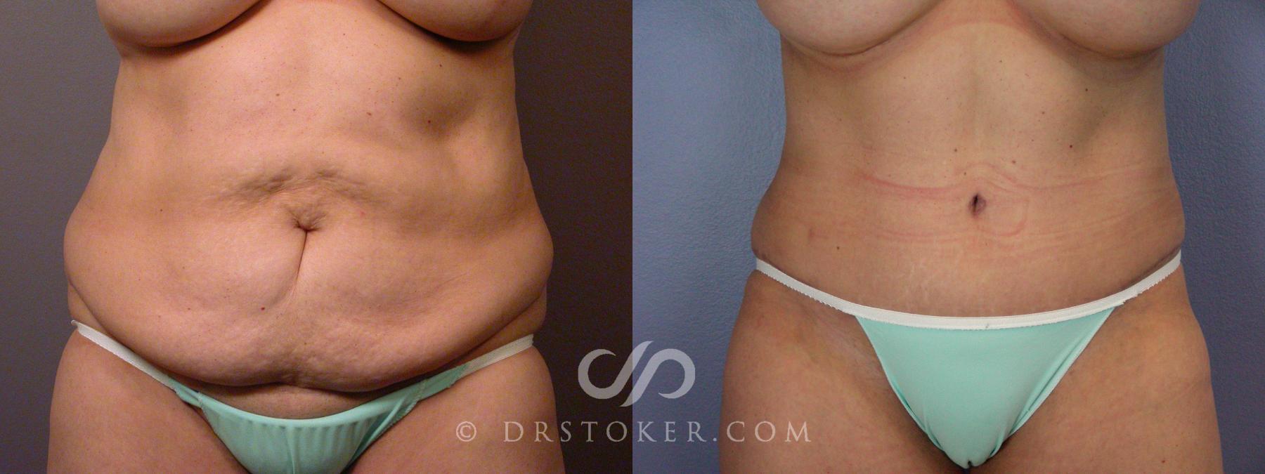 Before & After Breast Implant Correction Case 532 View #5 View in Los Angeles, CA