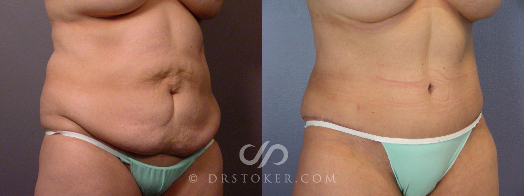 Before & After Breast Implant Correction Case 532 View #6 View in Los Angeles, CA