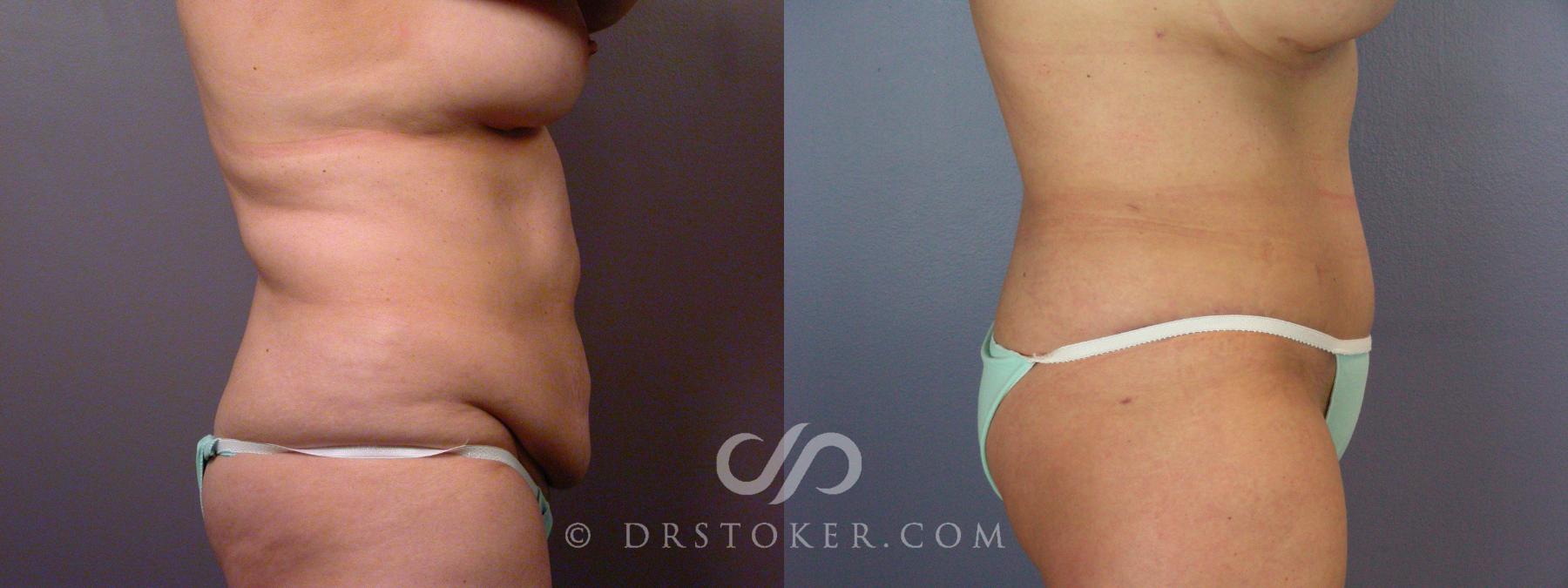 Before & After Breast Augmentation, Rapid Recovery Case 532 View #7 View in Los Angeles, CA