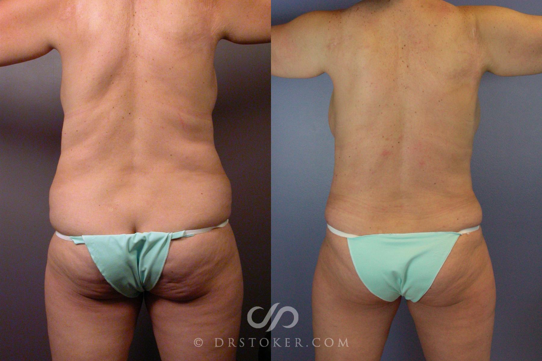 Before & After Breast Augmentation, Rapid Recovery Case 532 View #8 View in Los Angeles, CA