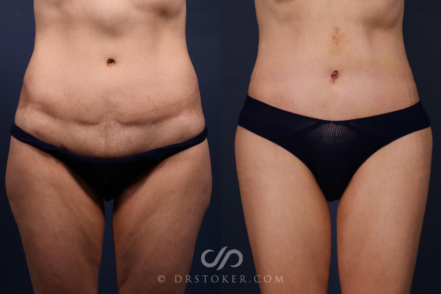 Before & After Revision Tummy Tuck  Case 2567 Front View in Los Angeles, CA