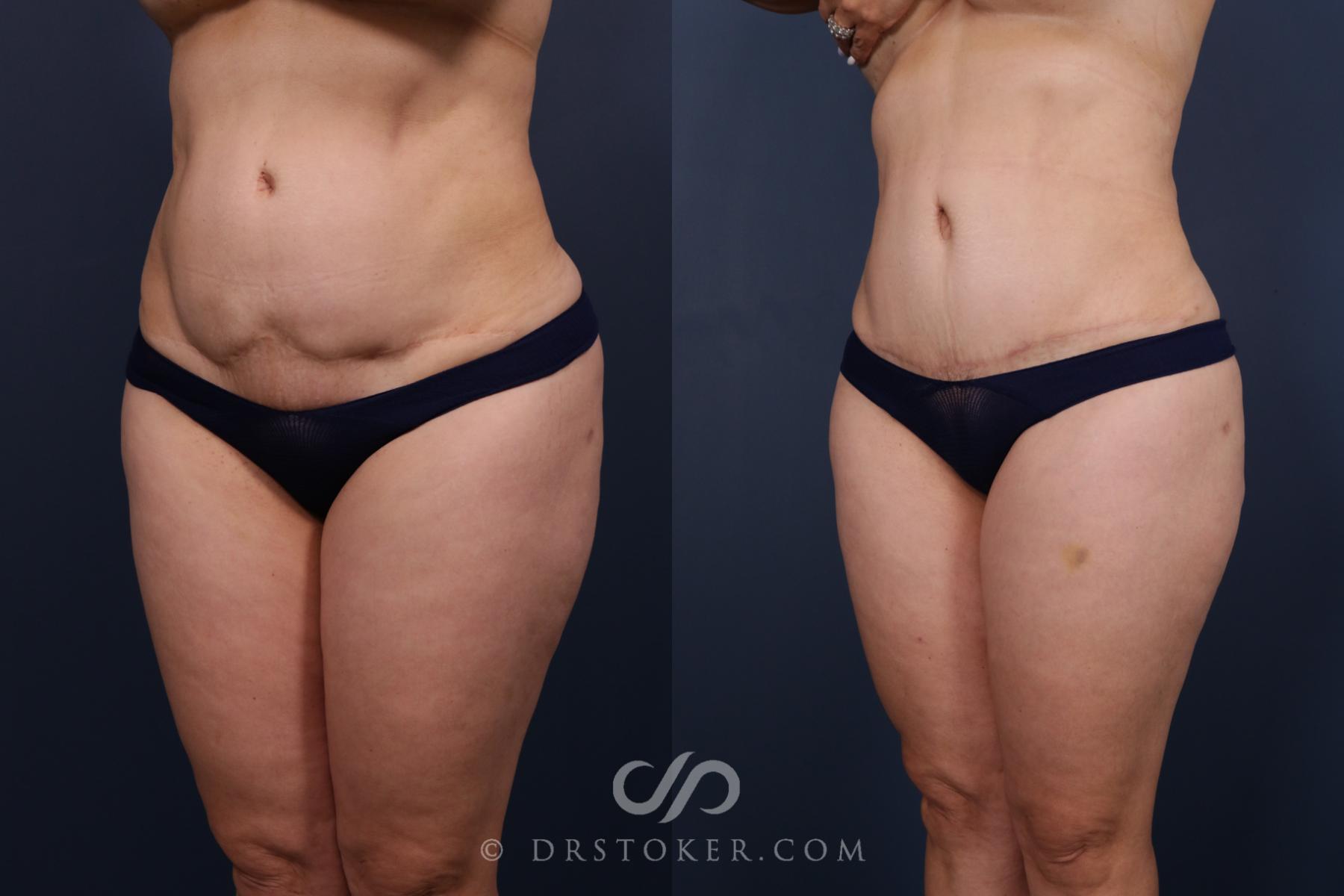 Before & After Revision Tummy Tuck  Case 2583 Left Oblique View in Los Angeles, CA