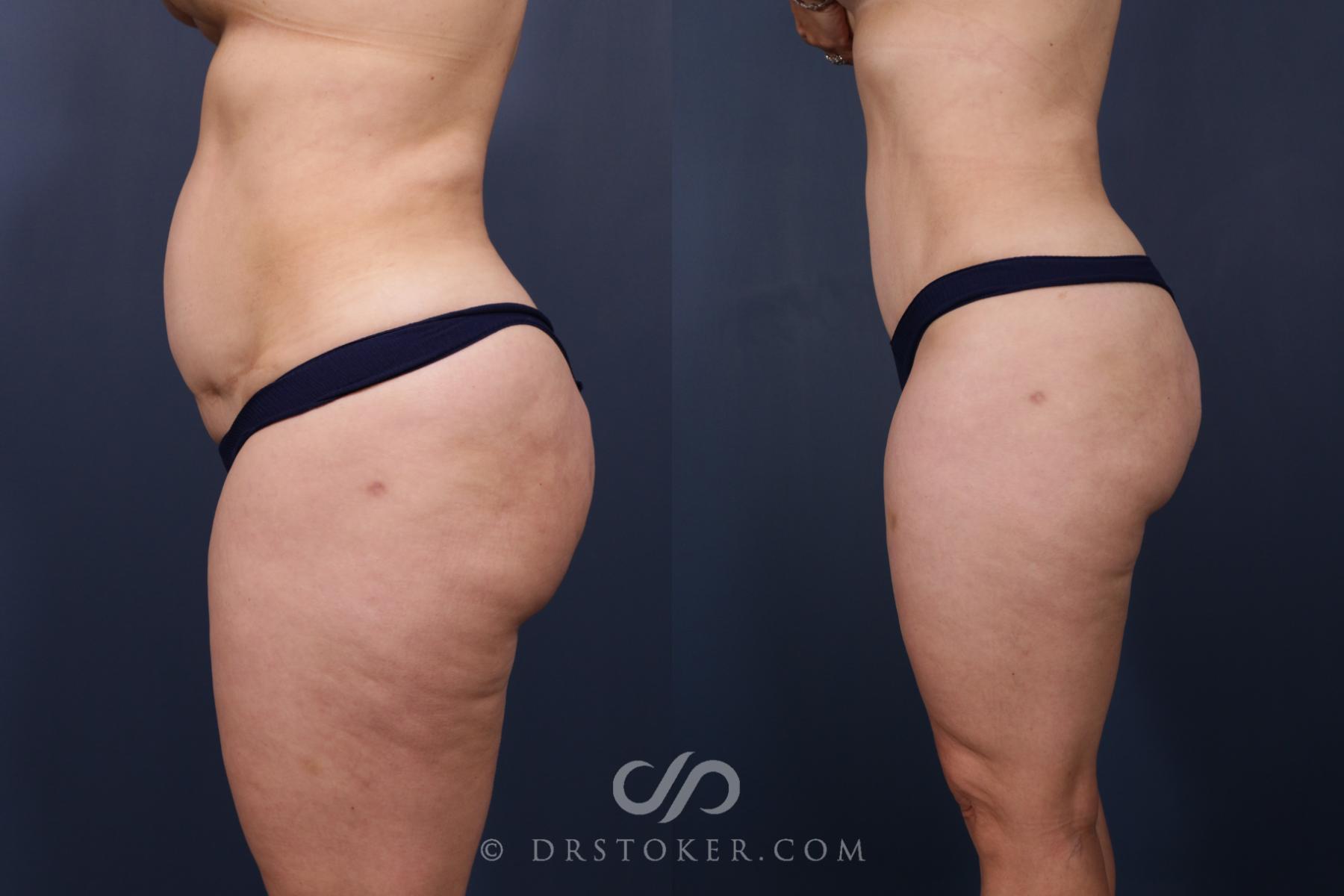 Before & After Revision Tummy Tuck  Case 2583 Left Side View in Los Angeles, CA