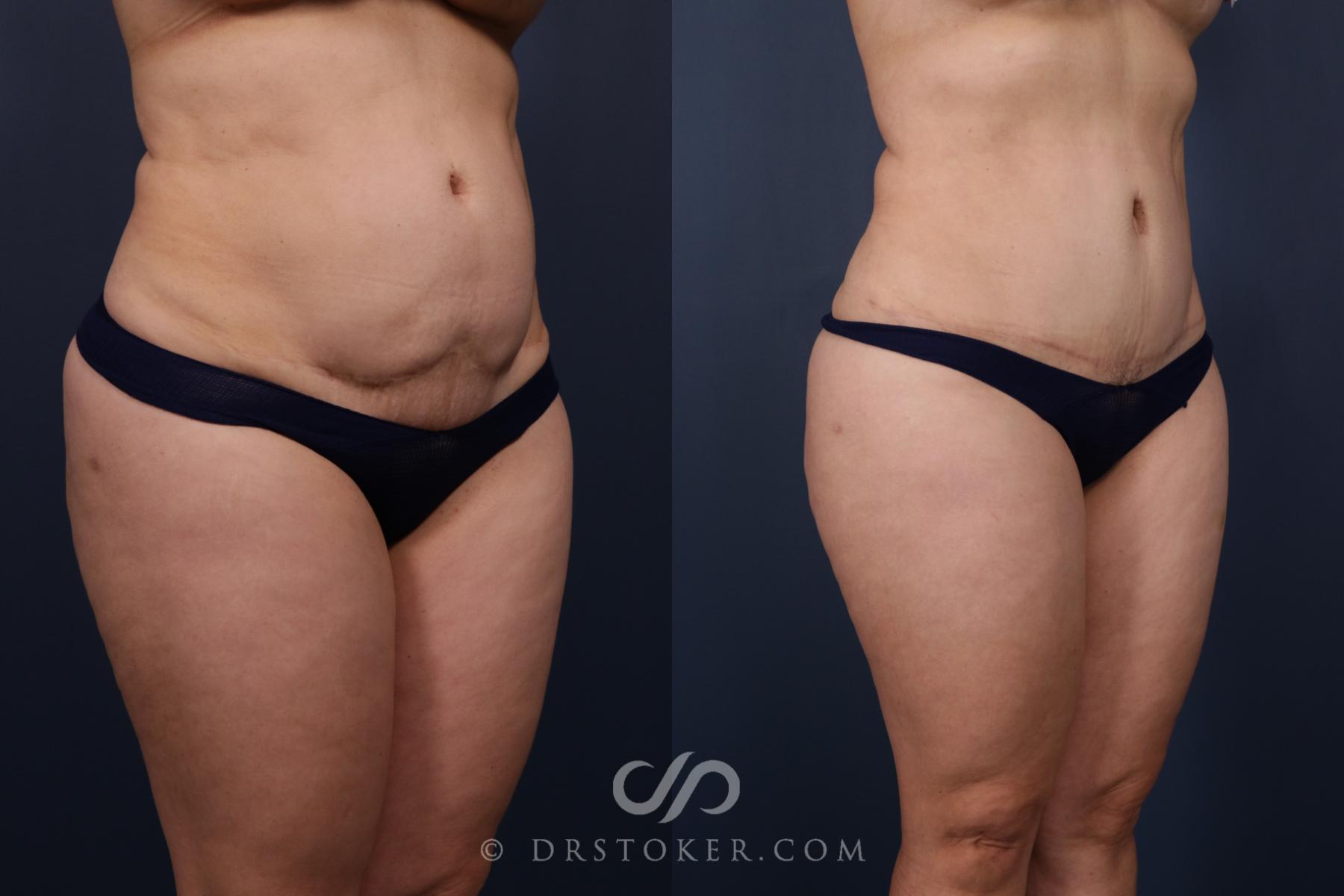 Before & After Revision Tummy Tuck  Case 2583 Right Oblique View in Los Angeles, CA