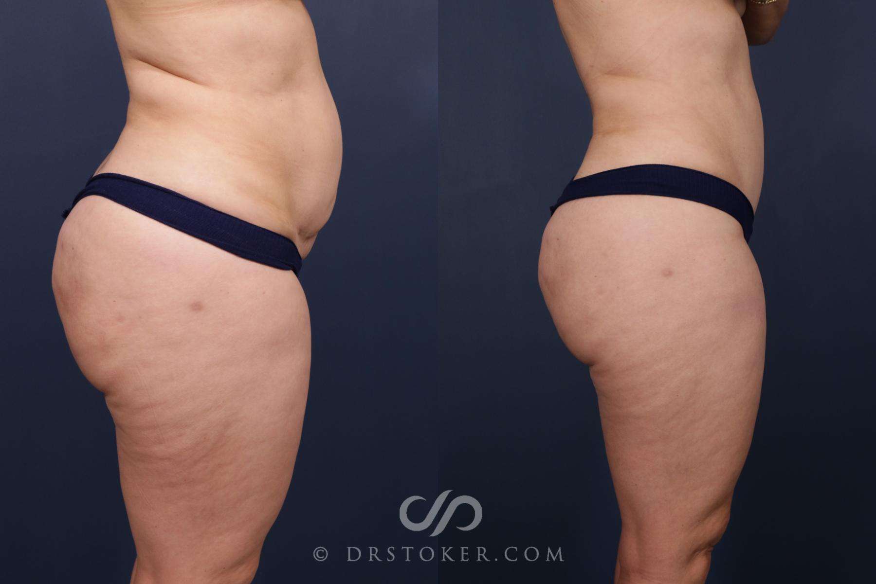 Before & After Revision Tummy Tuck  Case 2583 Right Side View in Los Angeles, CA