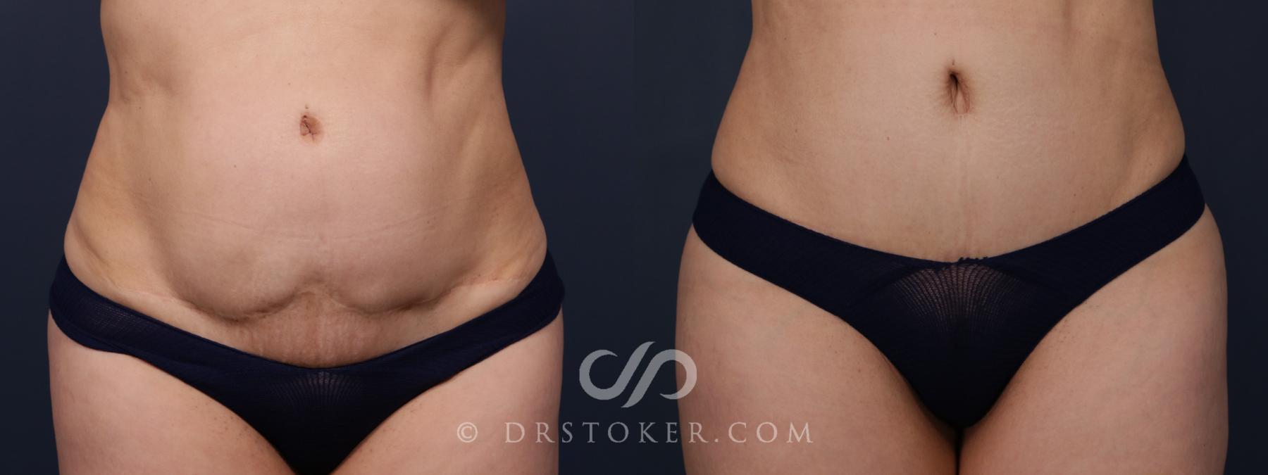 Before & After Revision Tummy Tuck  Case 2583 Tight Front View in Los Angeles, CA