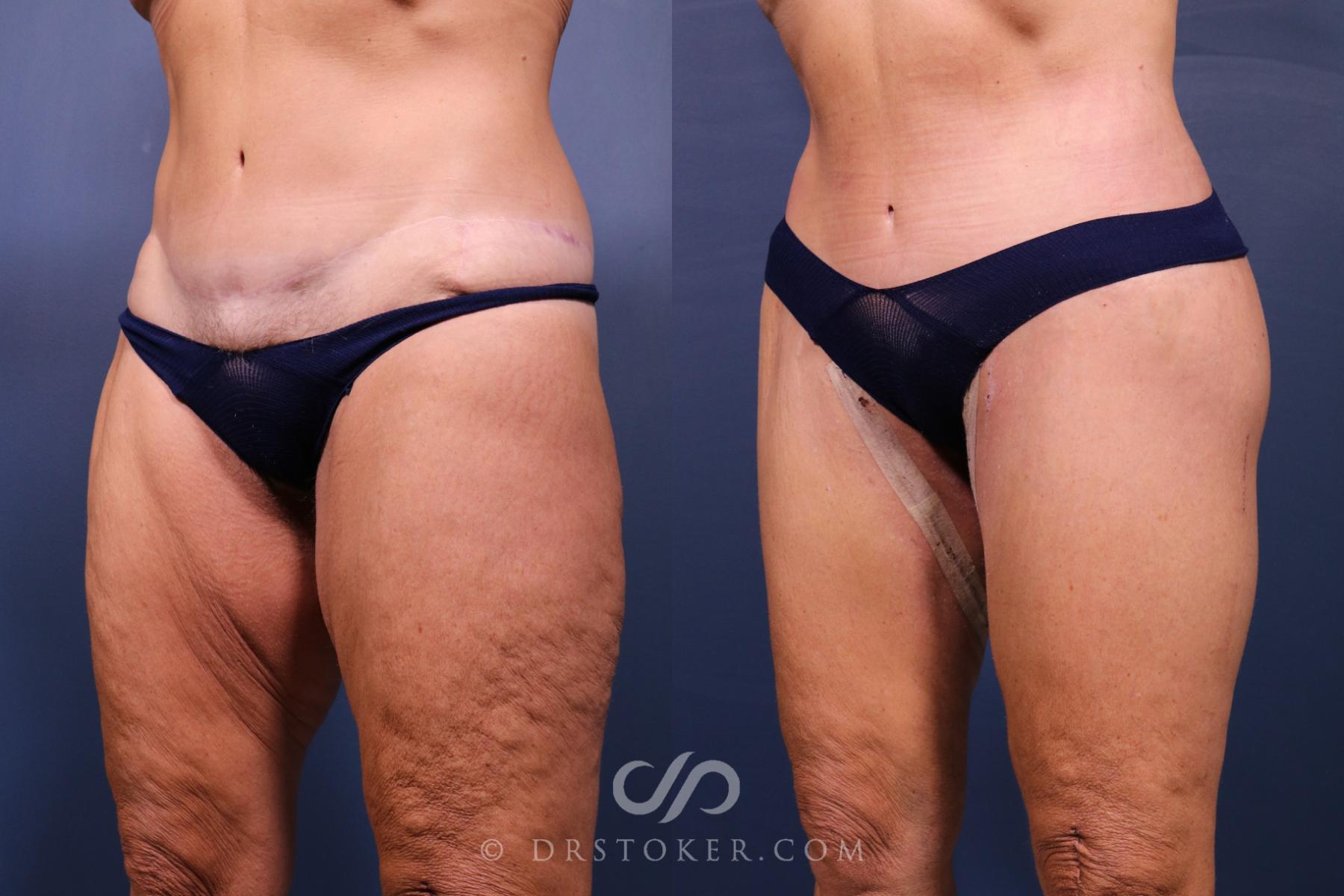 Before & After Revision Tummy Tuck  Case 2599 Left Oblique View in Los Angeles, CA