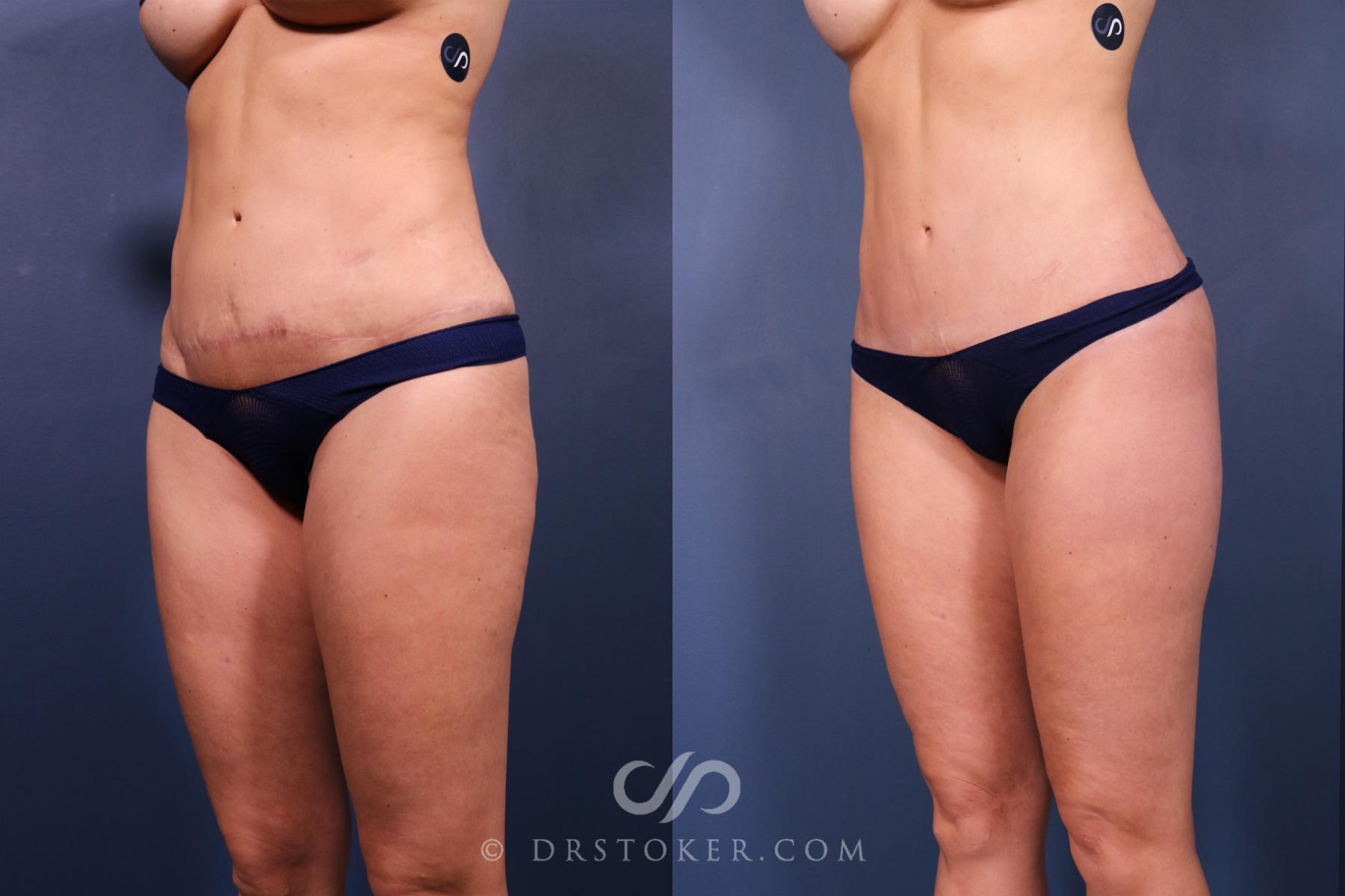 Before & After Revision Tummy Tuck  Case 2605 Left Oblique View in Los Angeles, CA