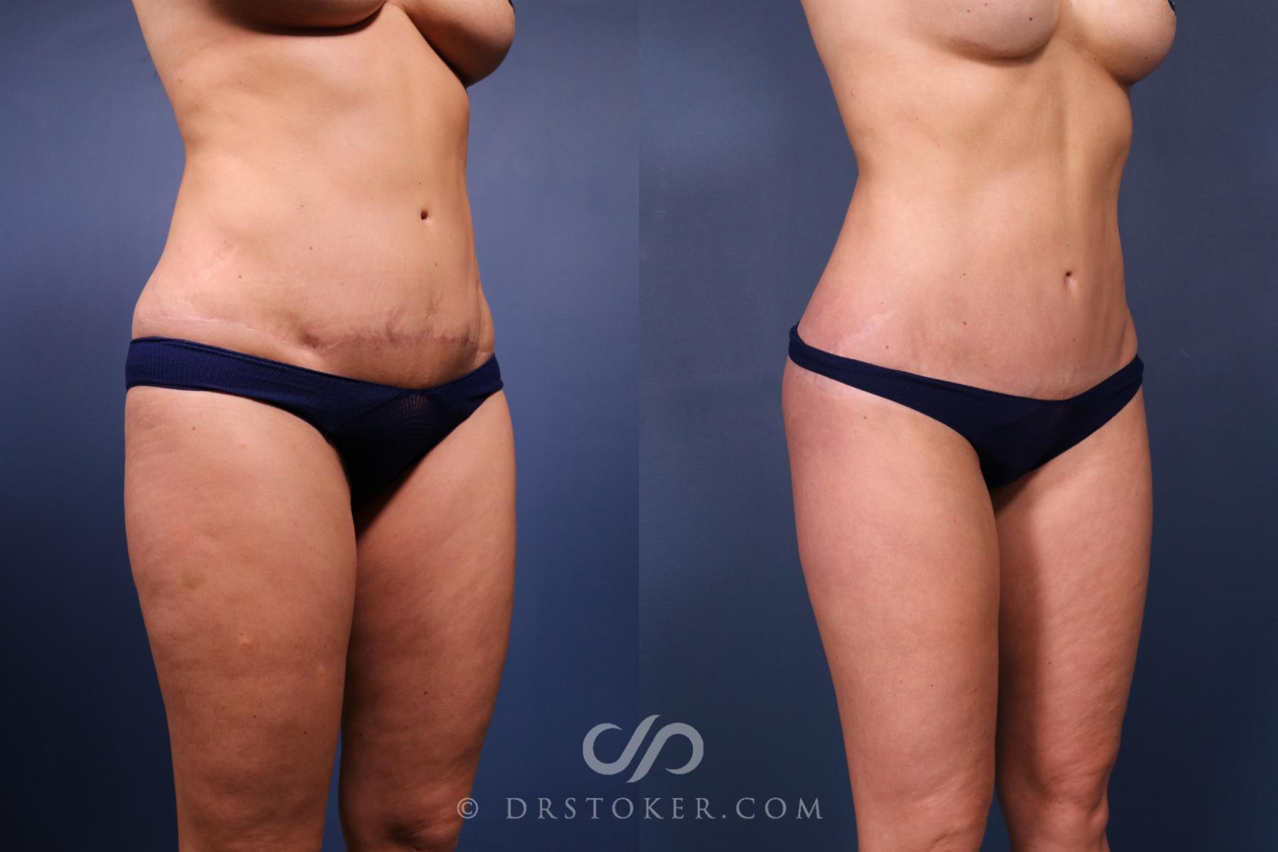 Before & After Revision Tummy Tuck  Case 2605 Right Oblique View in Los Angeles, CA