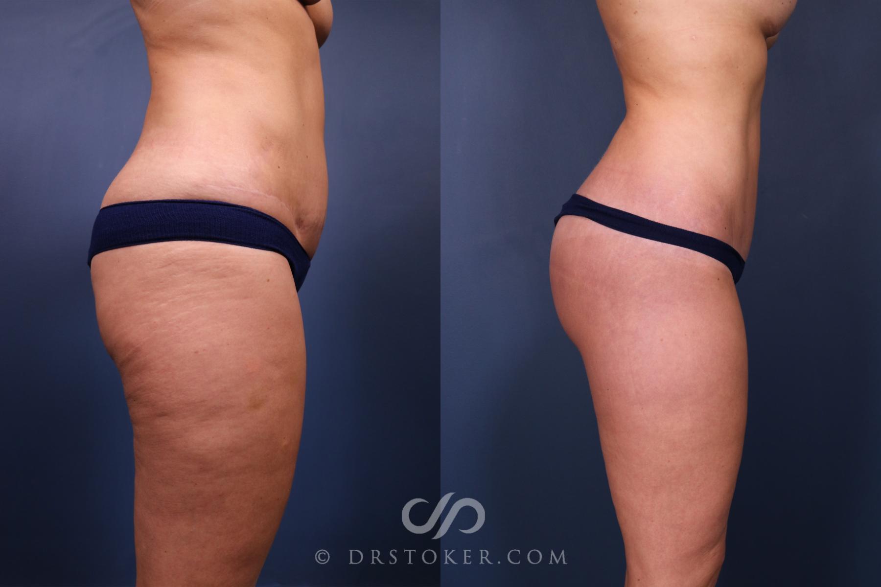Before & After Revision Tummy Tuck  Case 2605 Right Side View in Los Angeles, CA