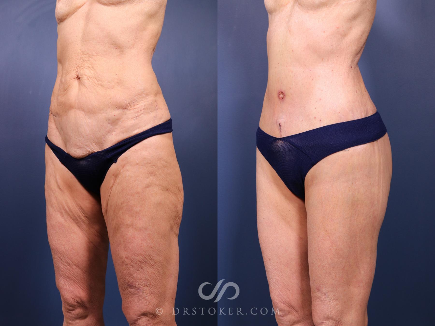 Before & After Revision Tummy Tuck  Case 2694 Left Oblique View in Los Angeles, CA