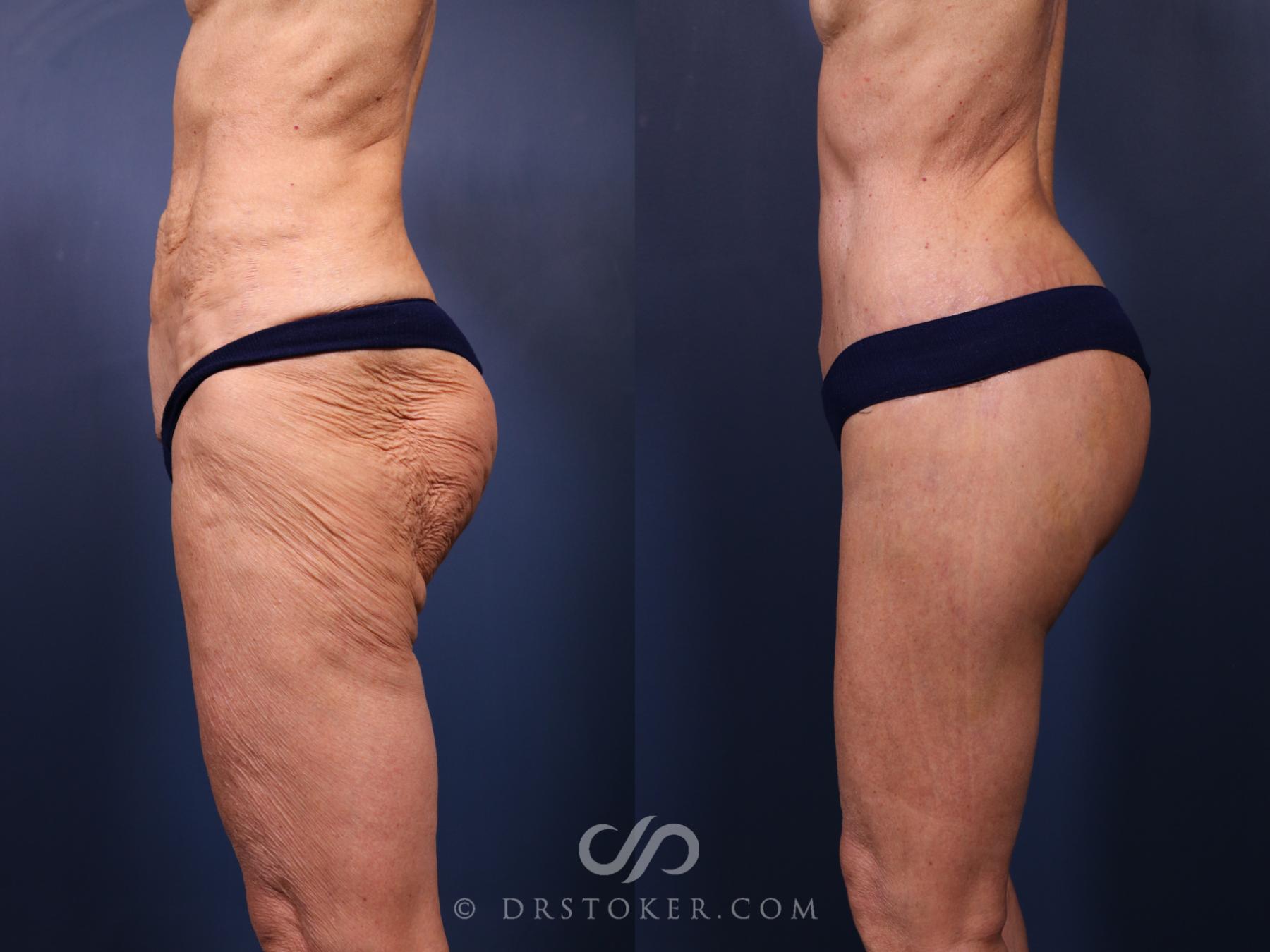 Before & After Revision Tummy Tuck  Case 2694 Left Side View in Los Angeles, CA