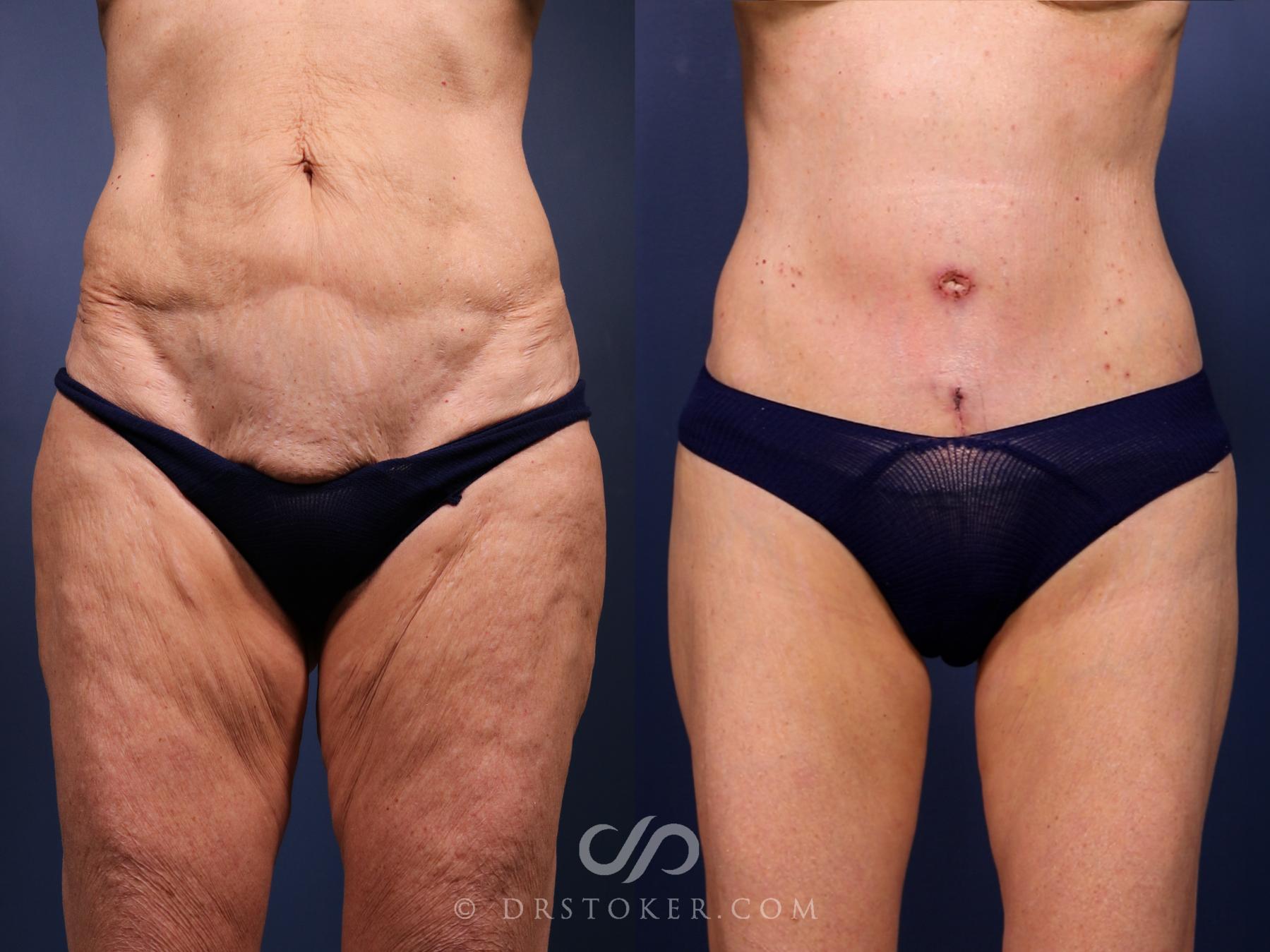Before & After Revision Tummy Tuck  Case 2695 Front View in Los Angeles, CA