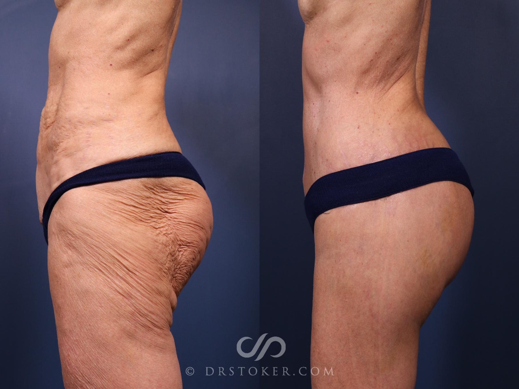 Before & After Revision Tummy Tuck  Case 2695 Left Side View in Los Angeles, CA