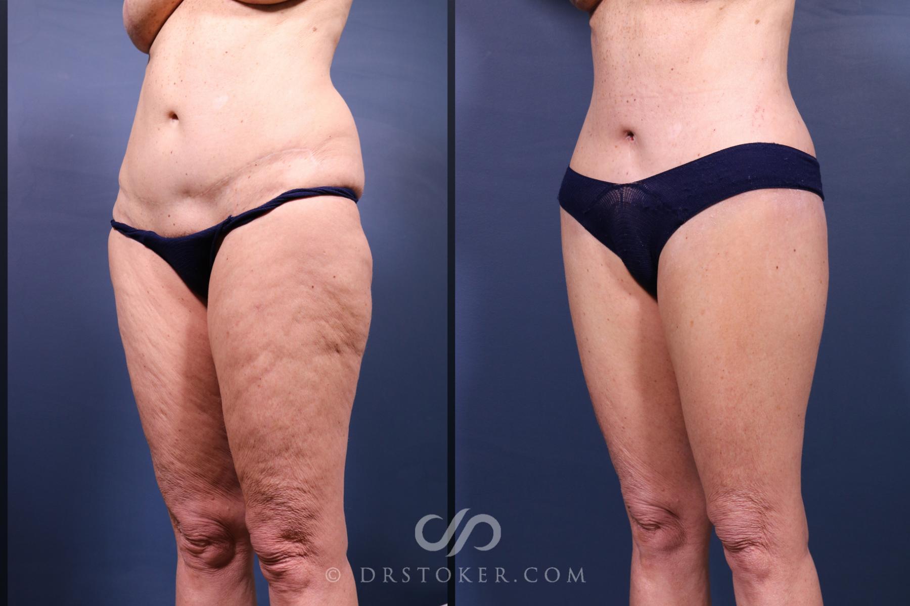 Before & After Revision Tummy Tuck  Case 2696 Left Oblique View in Los Angeles, CA