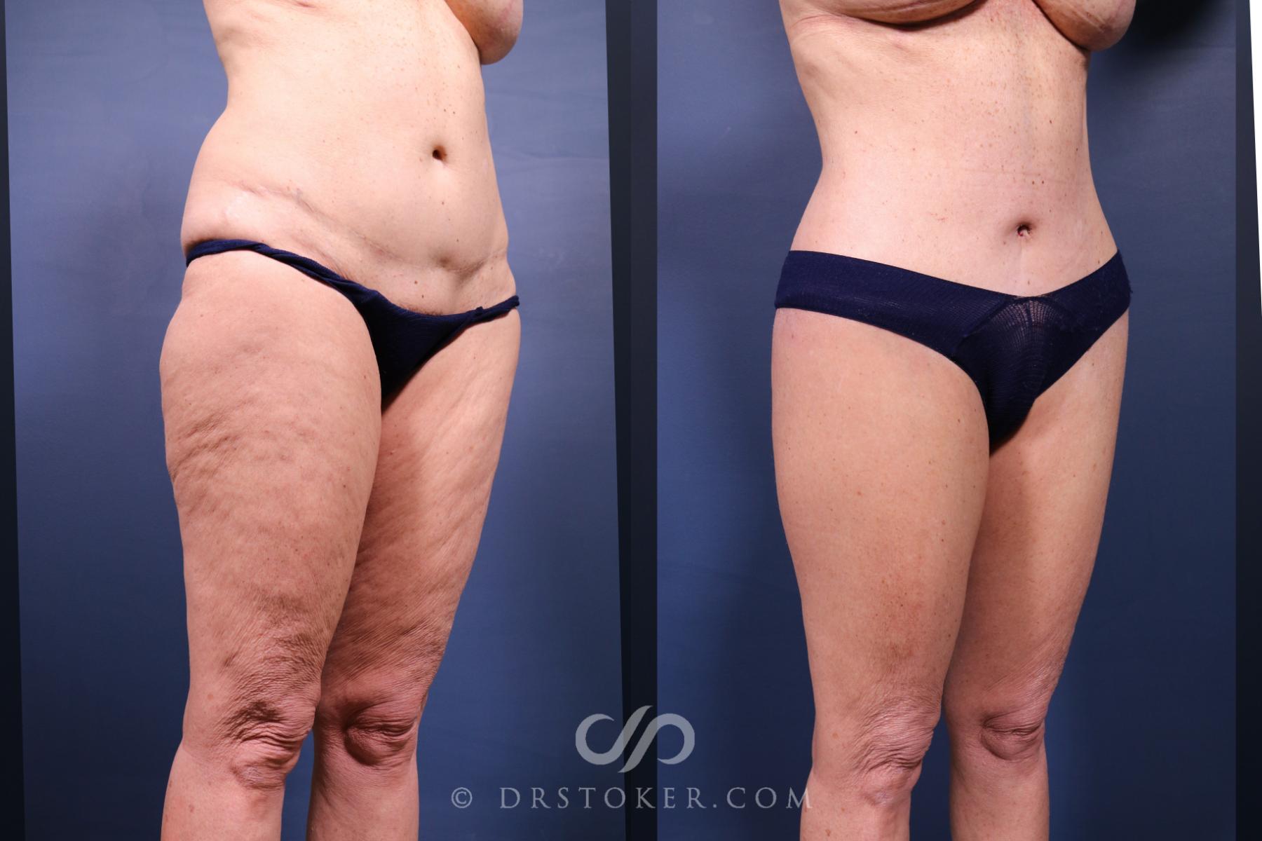 Before & After Revision Tummy Tuck  Case 2696 Right Oblique View in Los Angeles, CA
